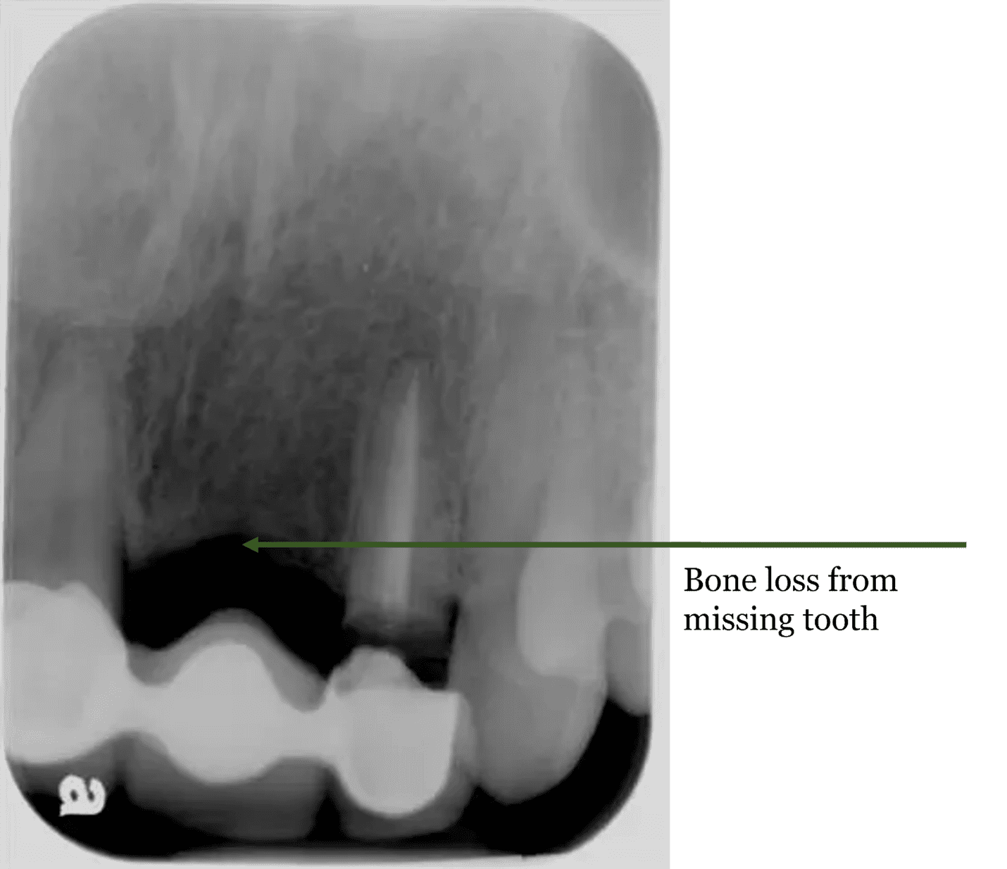 Bone Loss Image